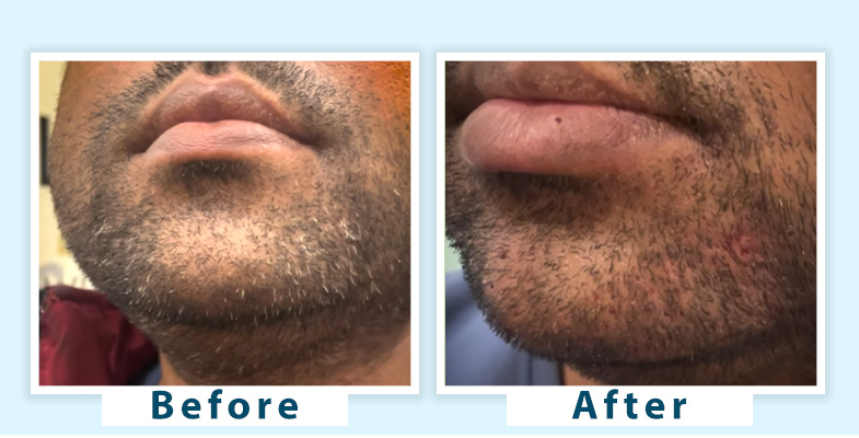 Top Permanent Solutions For Grey Beard Expert Advice And Treatments